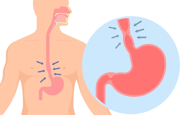 Esophageal Dilation